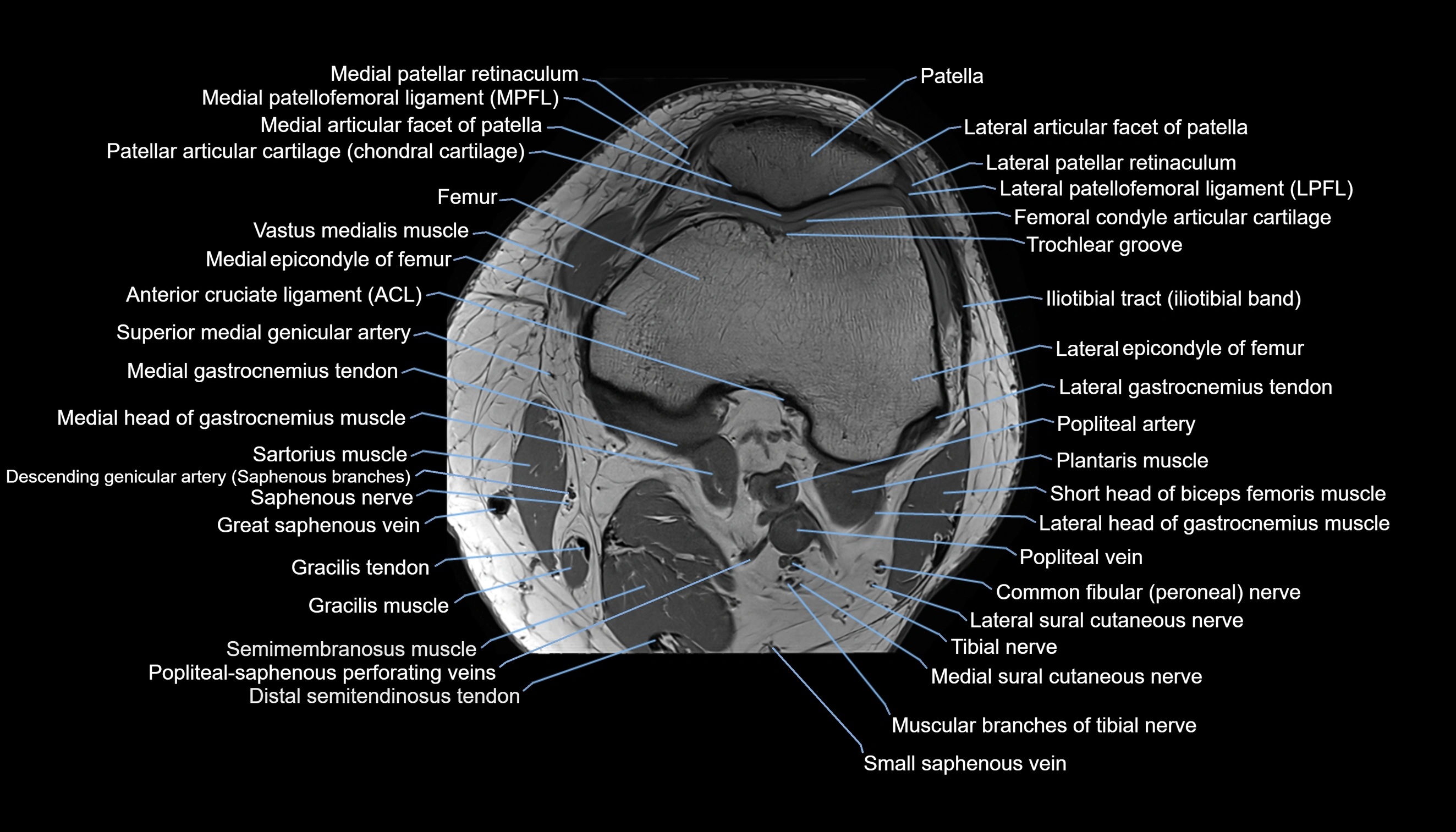 MRI knee  axial cross sectional anatomy 3T radiology  image-img-00001-00016.webp